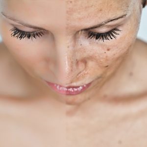 Sun Damage Repair
