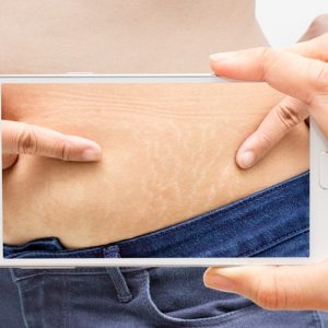 Smoother Skin Scar