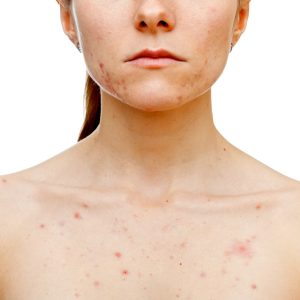 Acneclear Probiotic Skin Facial