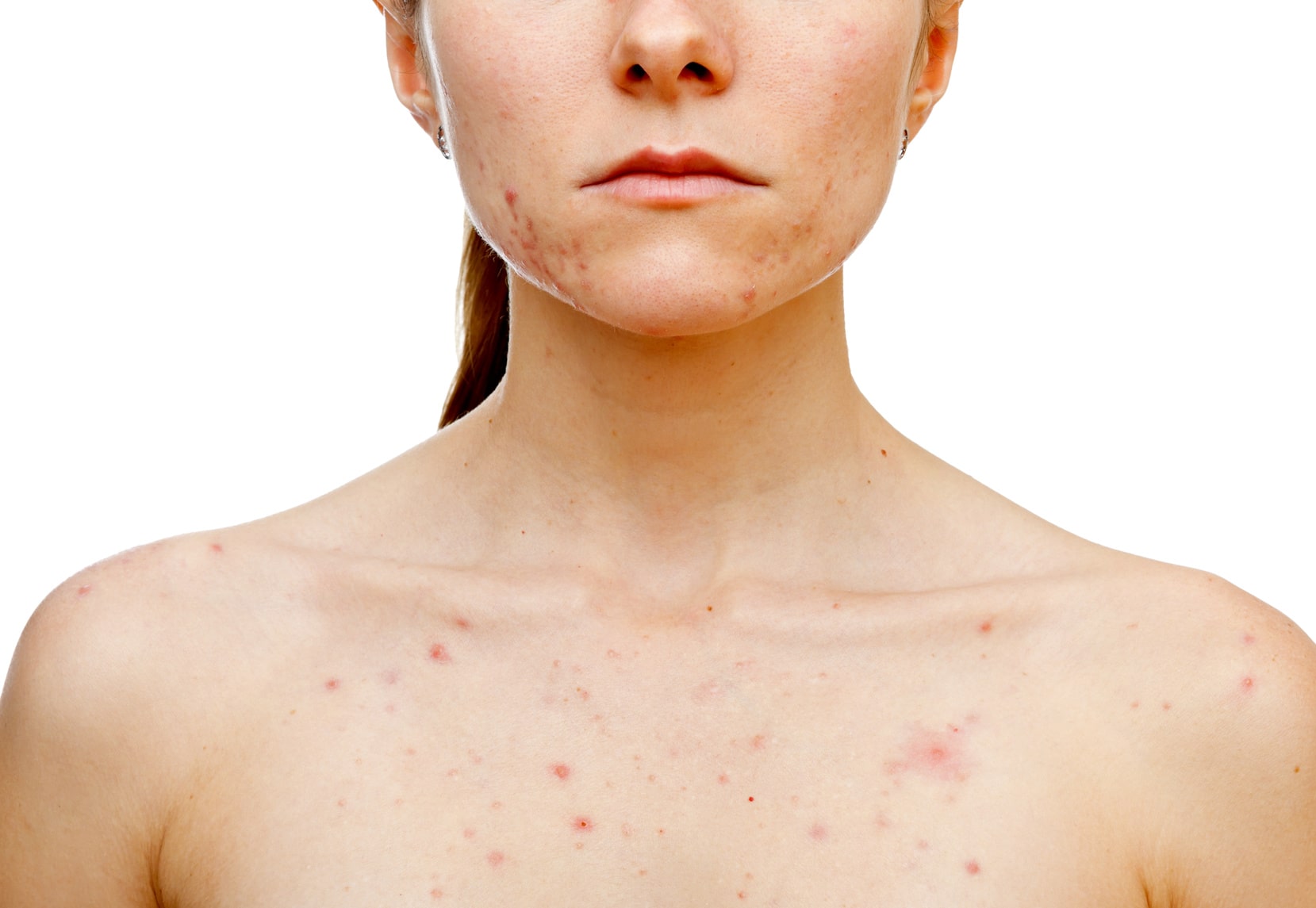 Acneclear Probiotic Skin Facial
