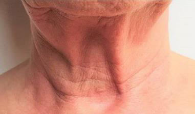 Turkey Neck Skin Tightening Treatment
