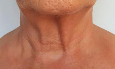 Turkey Neck Skin Tightening Treatment