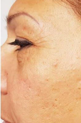 ChemPeel Skin Renew