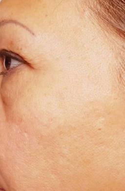 ChemPeel Skin Renew