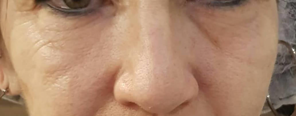 DermaBliss Redensify Facial