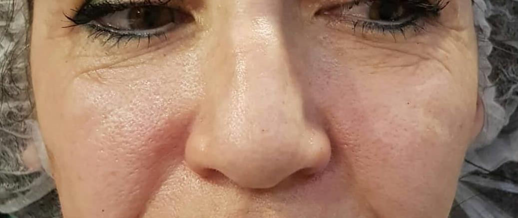 DermaBliss Redensify Facial