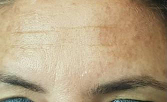 Best Skin Care Treatments