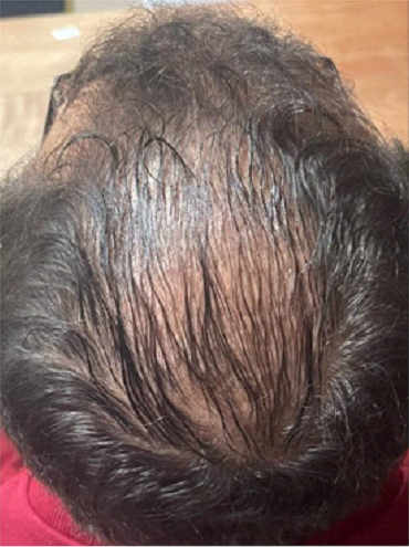 Hair Loss Treatment