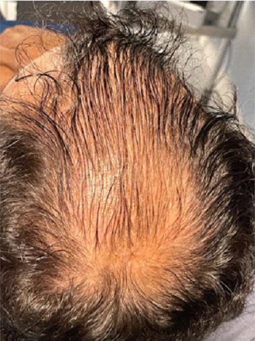 Hair Loss Treatment