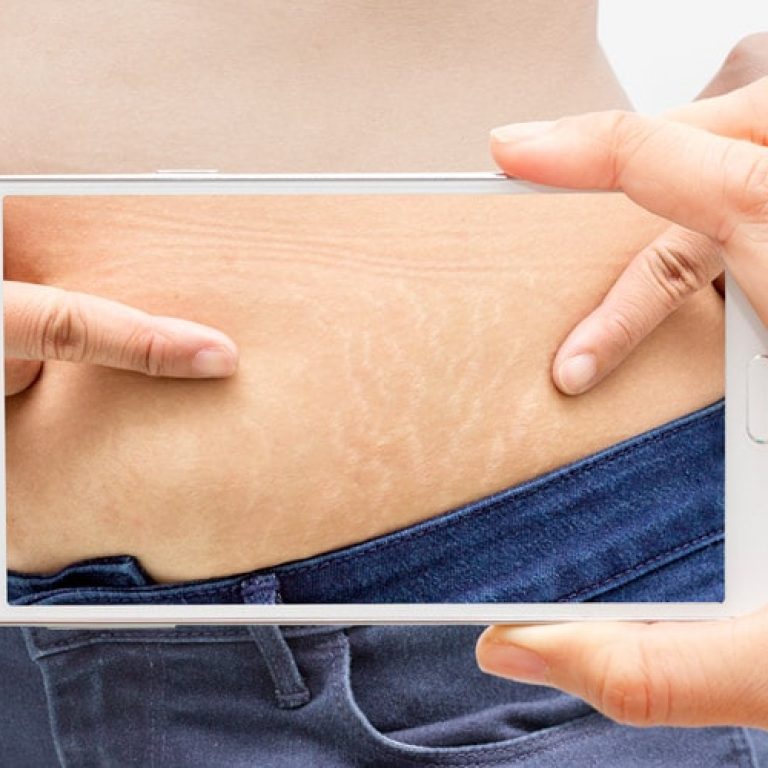 Essentia-stretchmarks-2-min